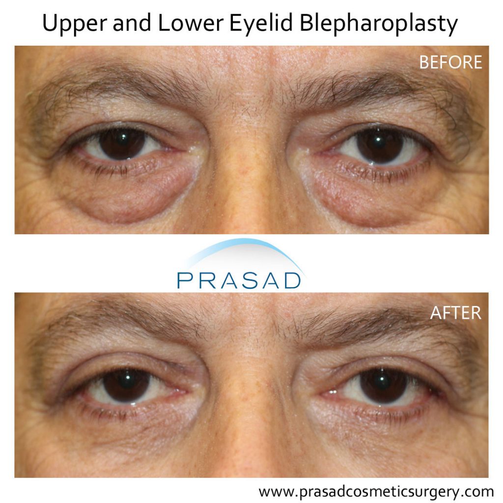 male eyelid surgery before and after