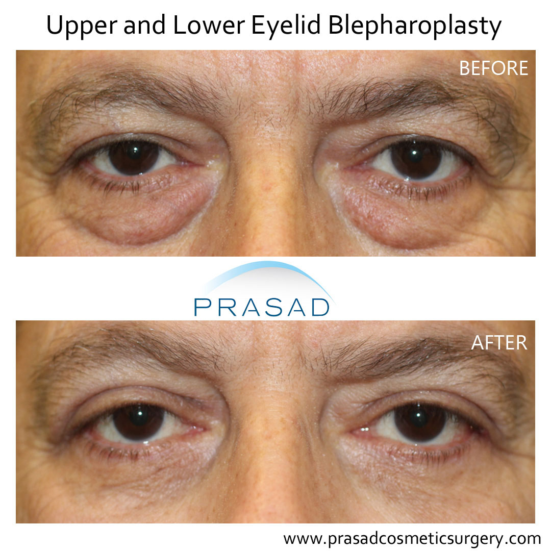 male eyelid surgery before and after