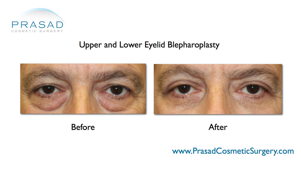 male eyelid surgery before and after