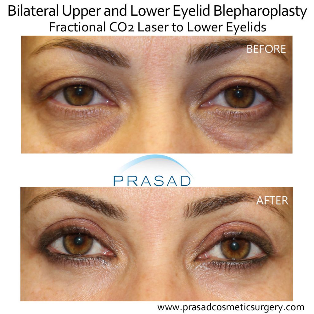 upper and lower blepharoplasty before and after performed in Prasad Cosmetic Surgery Manhattan office