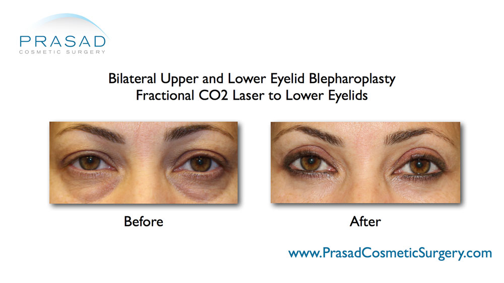 upper and lower blepharoplasty before and after performed in Prasad Cosmetic Surgery Manhattan office