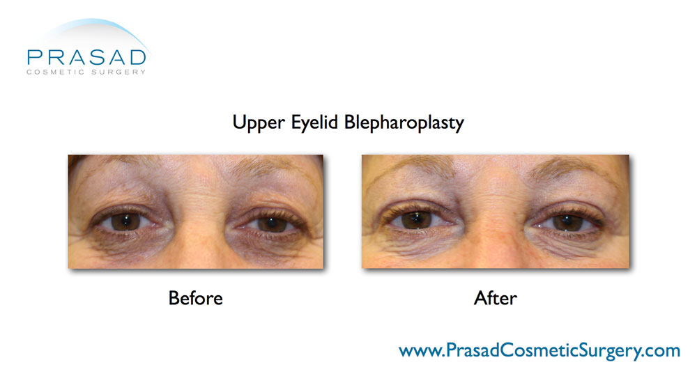 female upper blepharoplasty before and after
