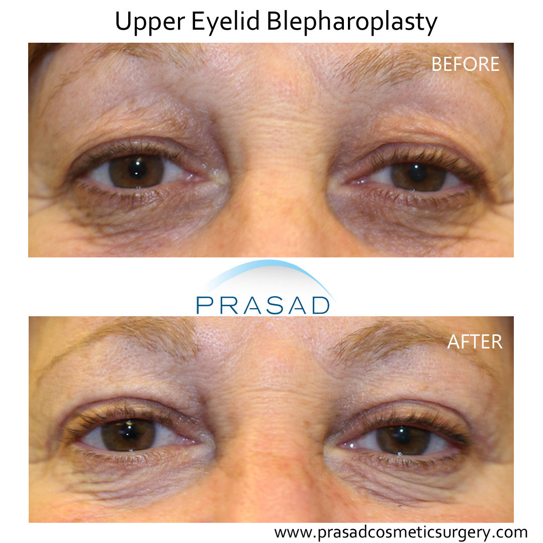 female upper blepharoplasty before and after