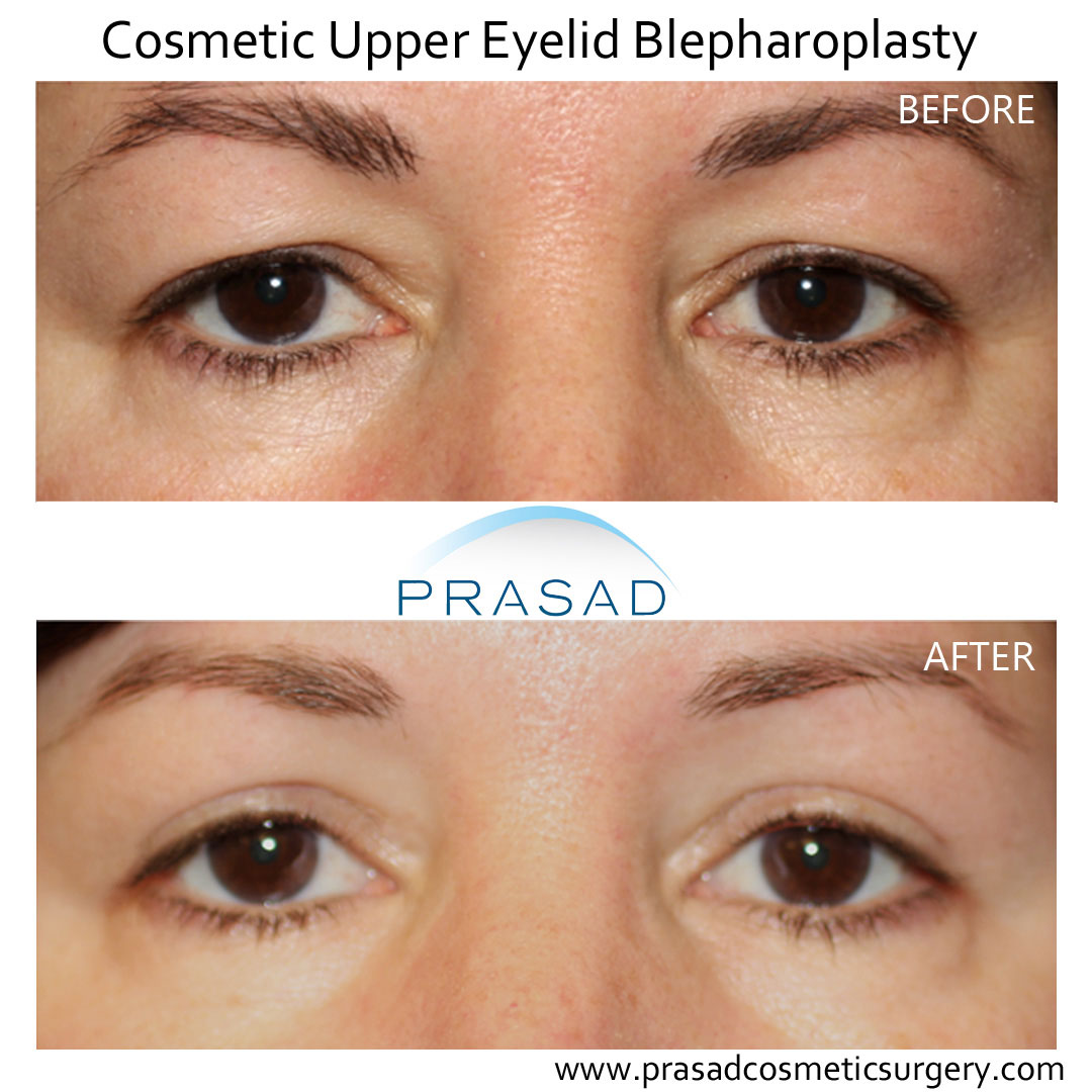 cosmetic upper eyelid surgery before and after
