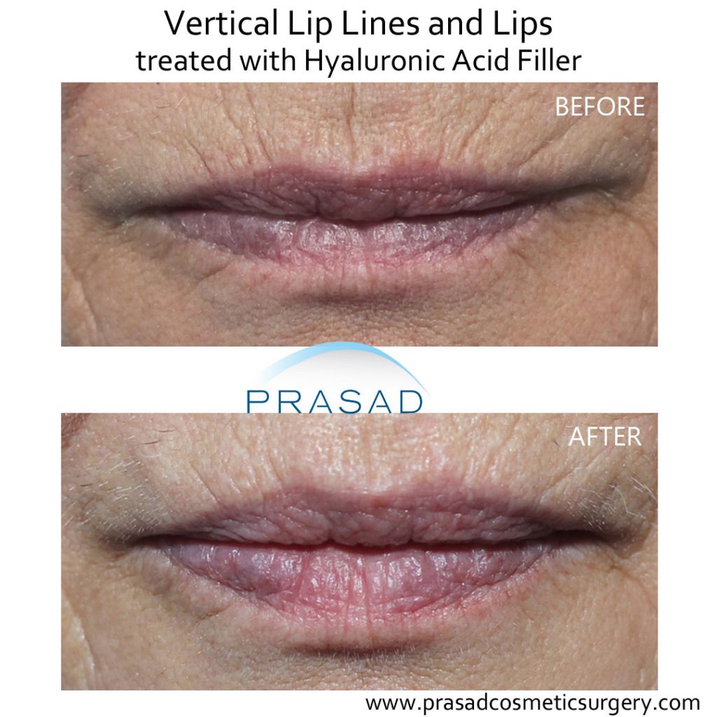 lip lines treatment before and after