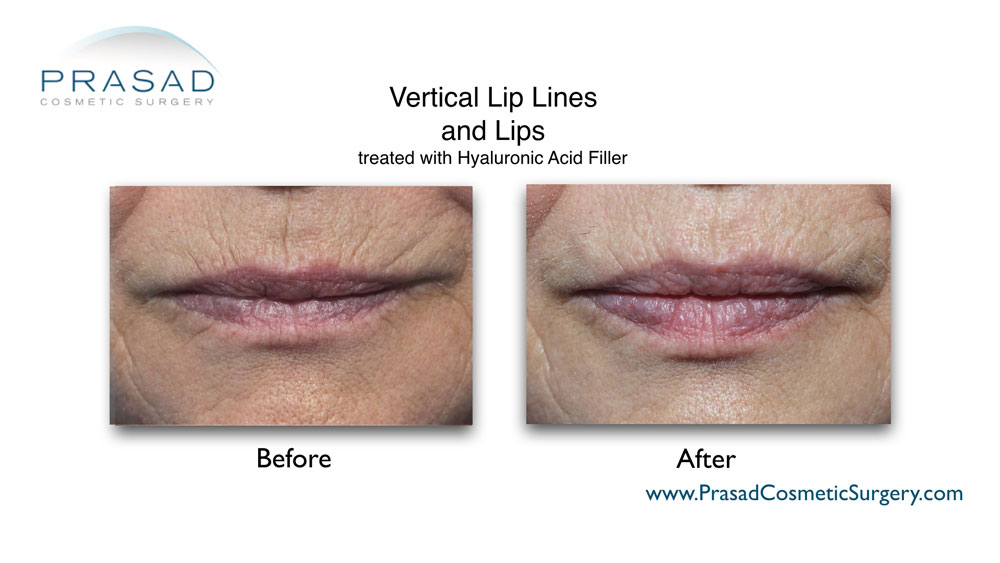 lip lines treatment before and after