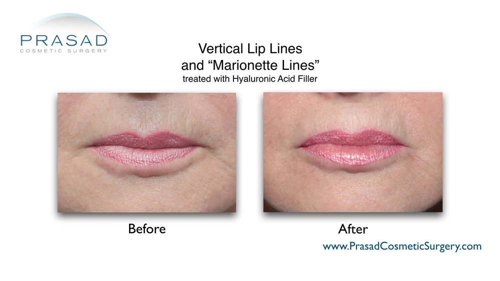 vertical lip lines treatment by Dr Amiya Prasad