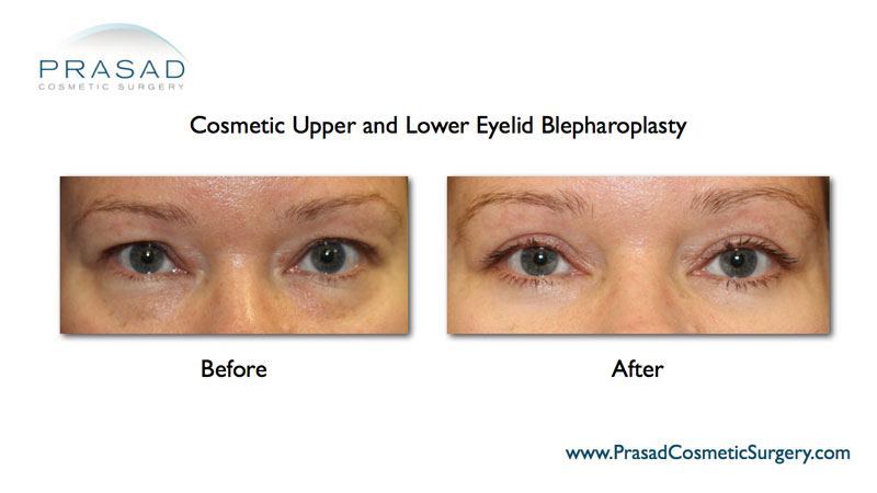 upper and lower blepharoplasty before and after