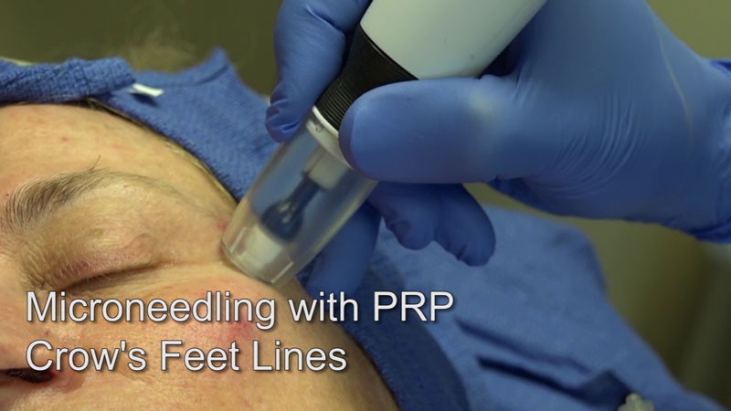 microneedling with platelet-rich plasma for crows feet