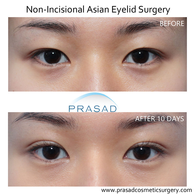 asian eyelid surgery recovery after 10 days