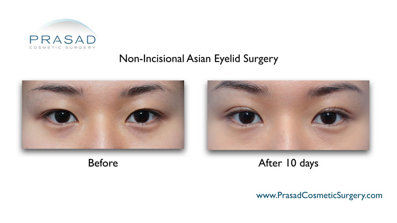 asian eyelid surgery recovery