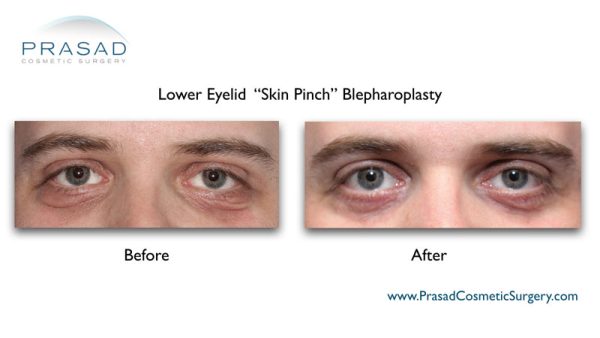 Does Lower Blepharoplasty Get Rid of Wrinkles? - Prasad Cosmetic Surgery