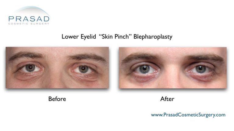 Is Lower Blepharoplasty Permanent? | Dr. Prasad Blog