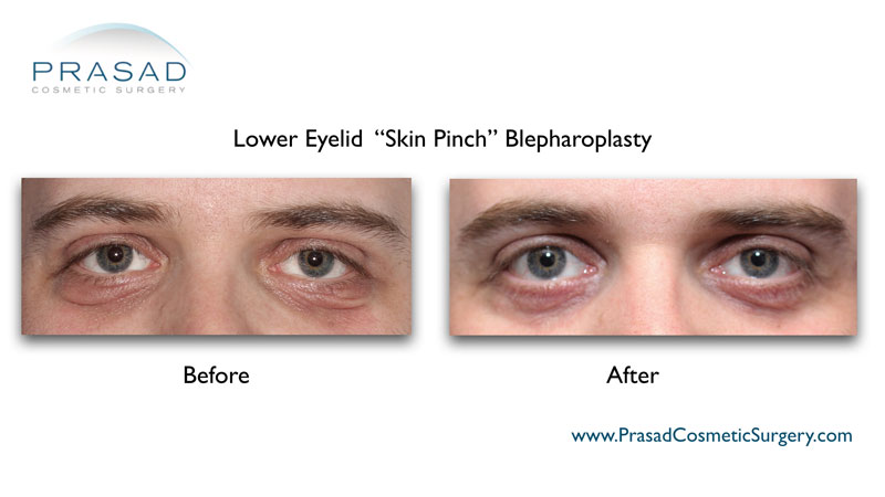 Skin pinch before and after surgery performed by Dr. Amiya Prasad