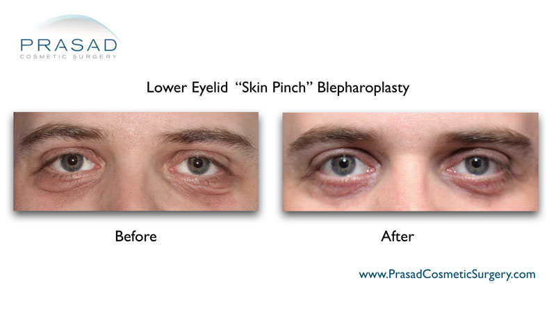 Does Lower Blepharoplasty Get Rid Of Wrinkles Prasad Cosmetic Surgery