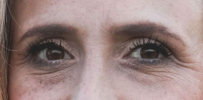 does lower blepharoplasty get rid of wrinkles? - woman with under eye wrinkles