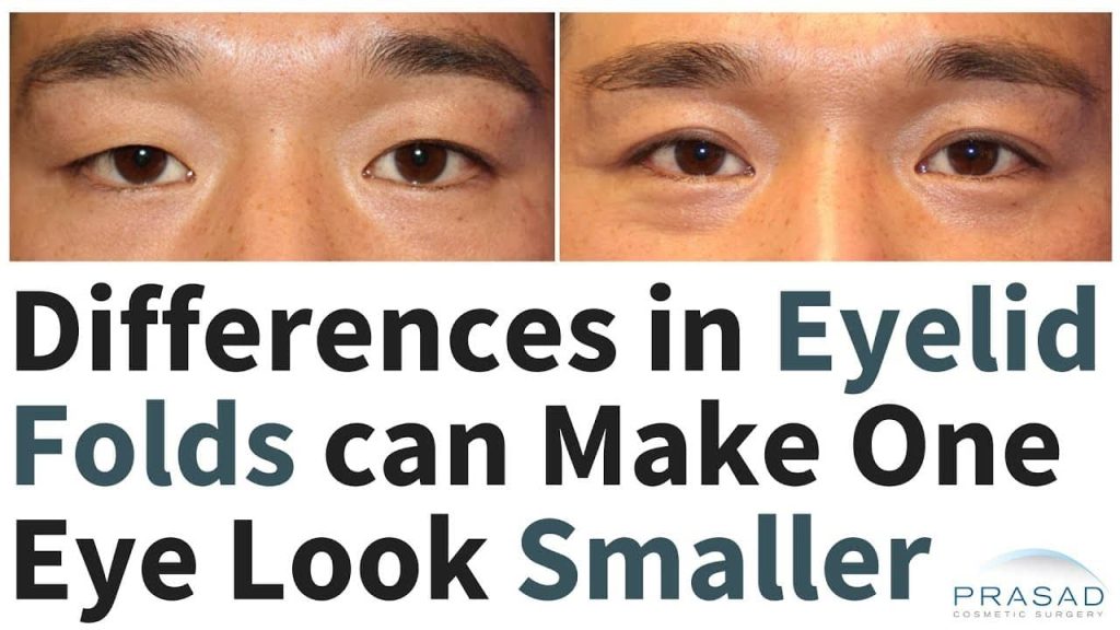 why one eye is smaller than the other