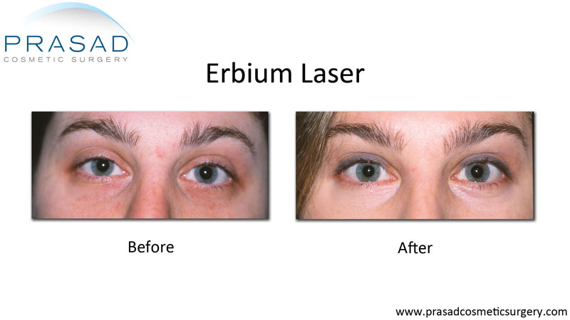 Erbium laser before and after for under eyes