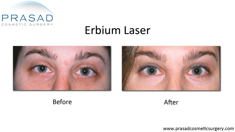 Does Lower Blepharoplasty Get Rid of Wrinkles? - Prasad Cosmetic Surgery