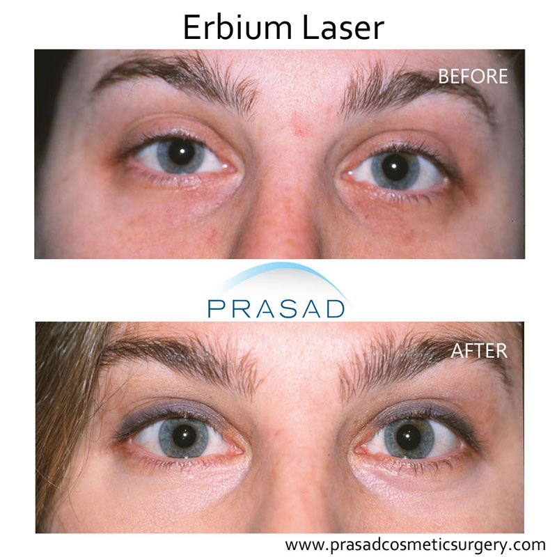 Erbium laser before and after for under eyes