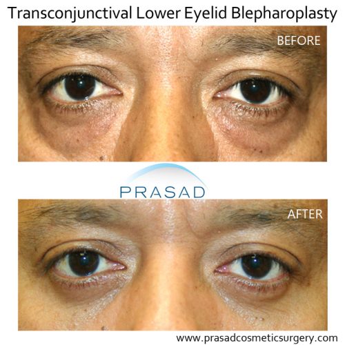 Eye Bag Removal Surgery Procedure, Risks, Recovery