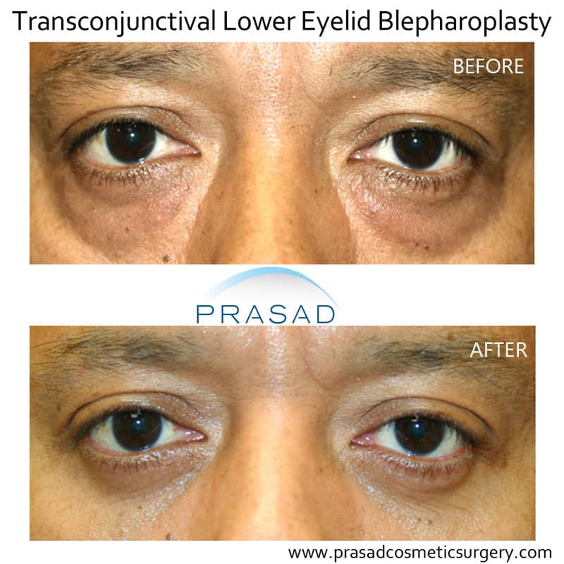 eye bag surgery before and after