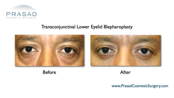 Minimizing Eyelid Surgery Scars in Darker Skin & Keloid-Prone Skin