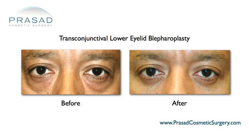 eye bag surgery before and after