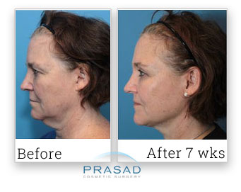 facelift before and after recovery 7 weeks