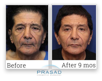 male facelift before and after 9 months