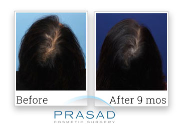 female hair loss treatment before and after 9 months