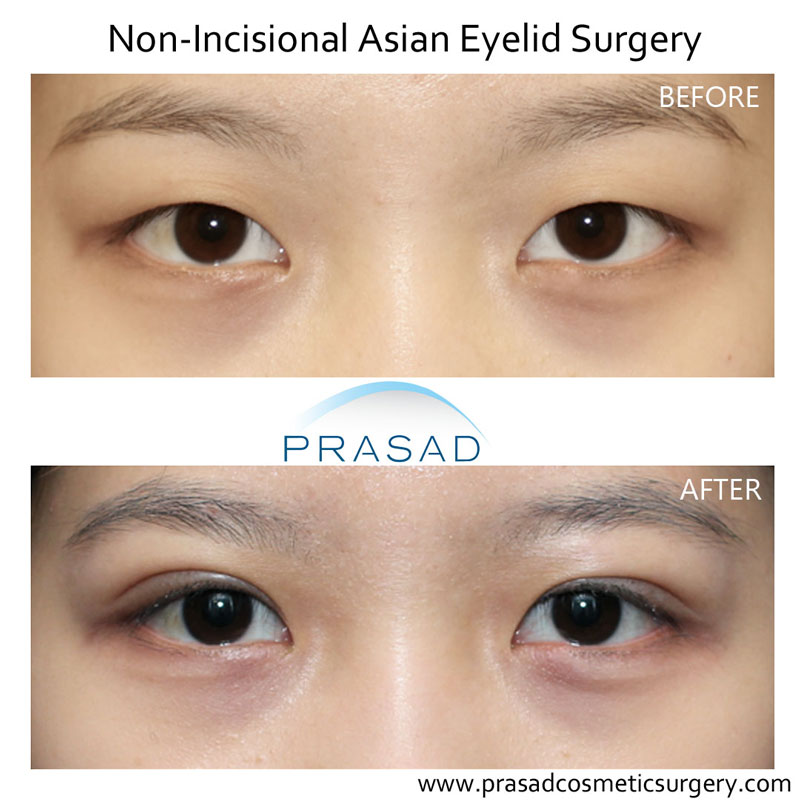 Asian double eyelid surgery before and after - non incisional procedure before and after