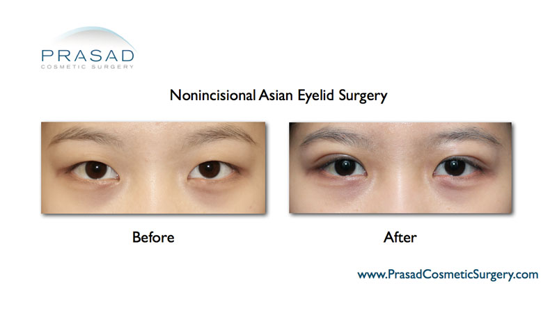 Asian double eyelid surgery before and after - non incisional procedure
