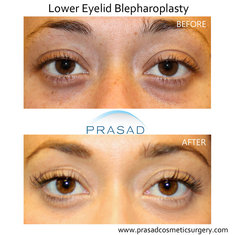 lower eyelid blepharoplasty before and after