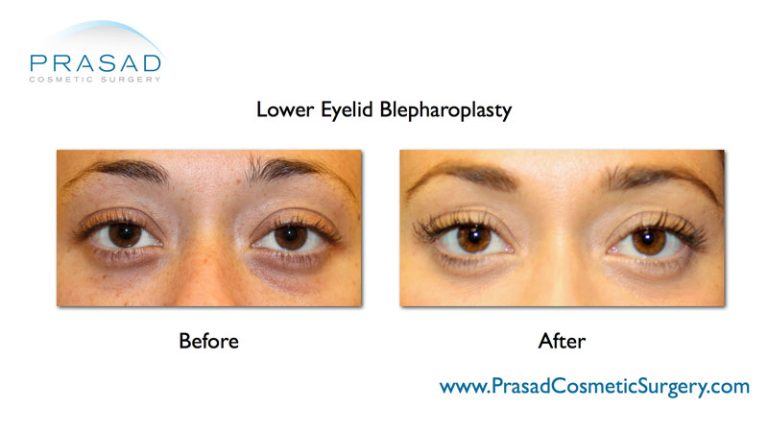 lower eyelid blepharoplasty before and after
