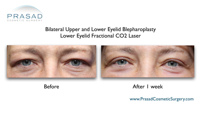 upper and lower blepharoplasty with fractional CO2 Laser recovery before and after 1 week recovery