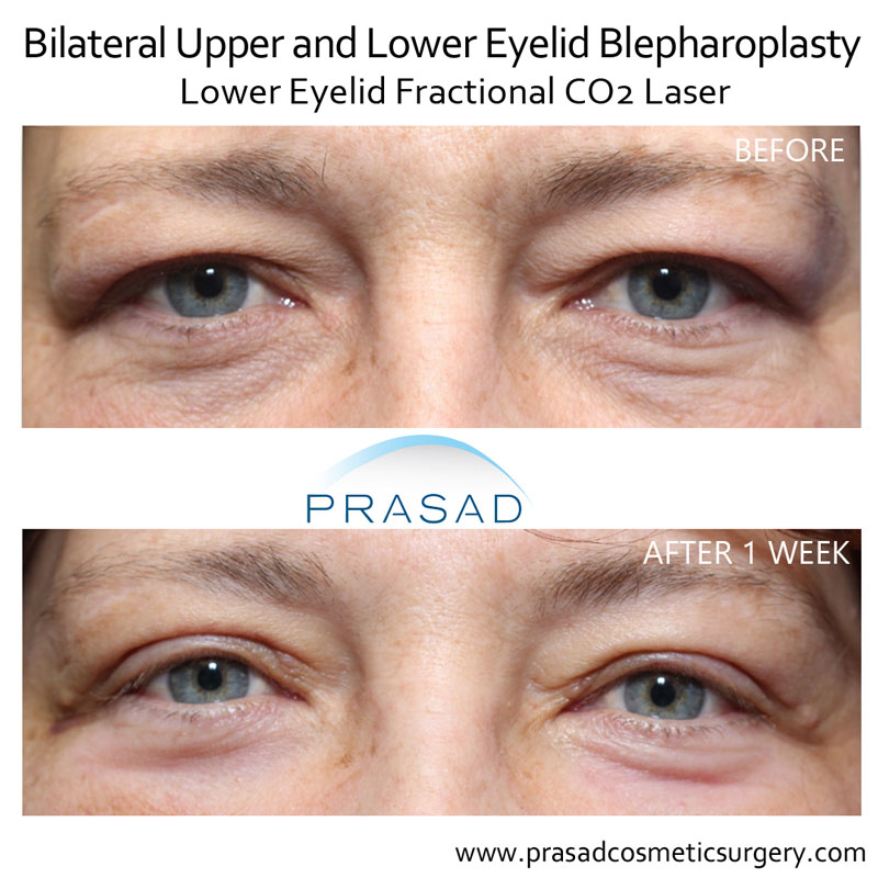 upper and lower eyelid blepharoplasty with fractional CO2 Laser before and after 1 week recovery