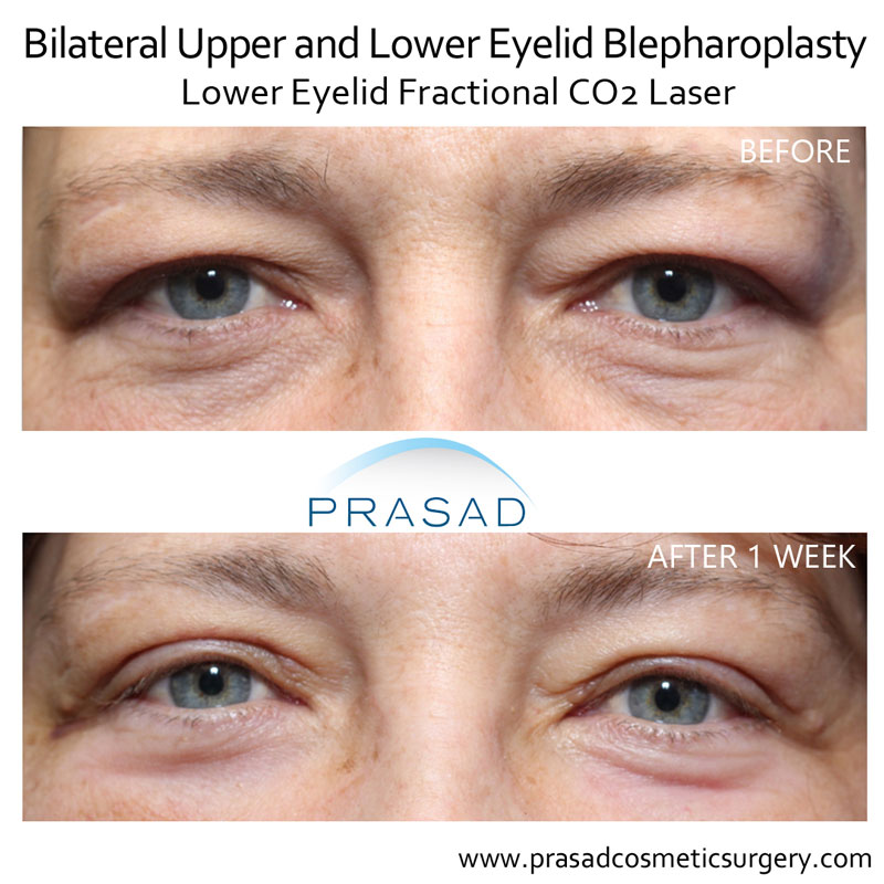 Does Lower Blepharoplasty Get Rid of Wrinkles Prasad Cosmetic