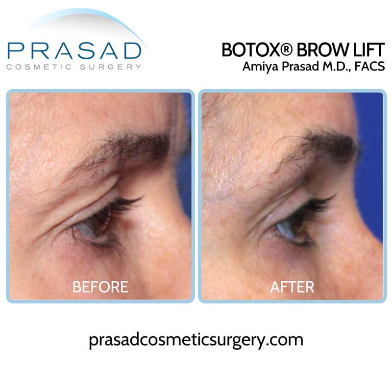 brow lift botox before and after