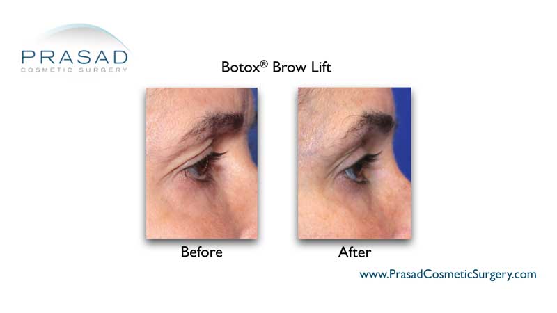 brow lift botox before and after