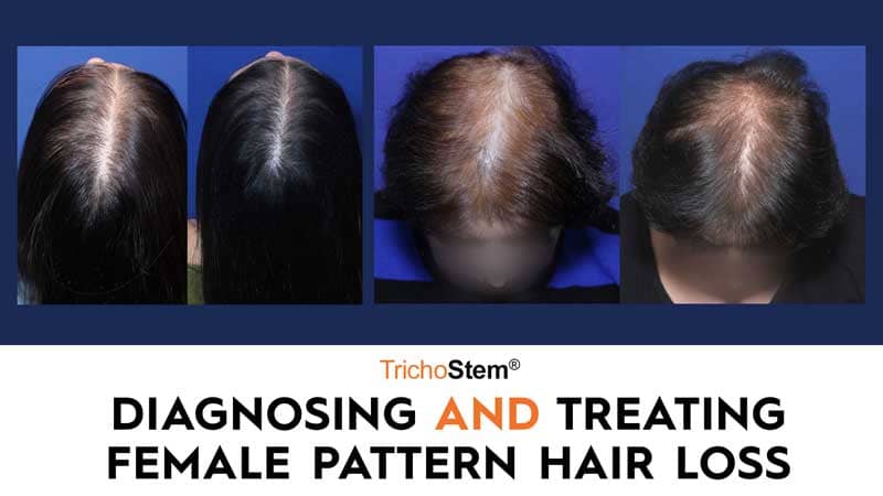 Diagnosing and Treating Androgenetic Alopecia in Women