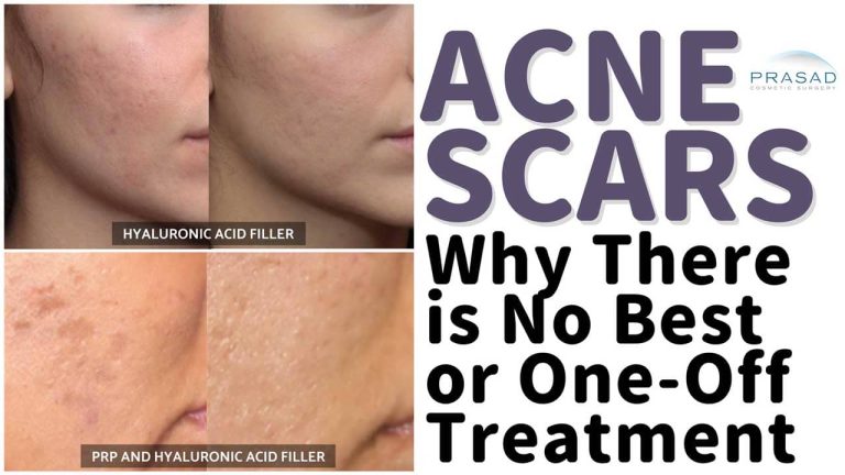 acne scars why there is no single treatment