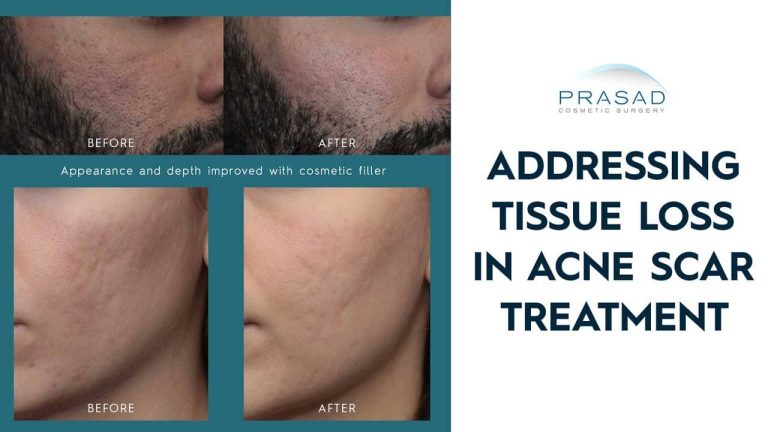 addressing tissue loss in acne scar treatment