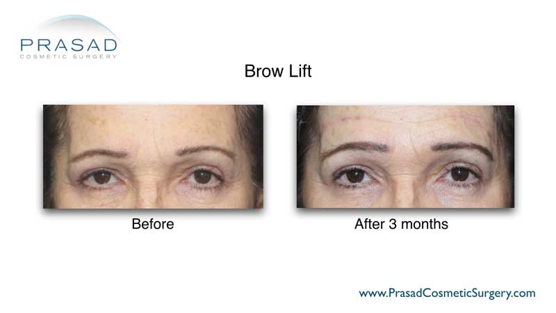 brow lift surgery before and after