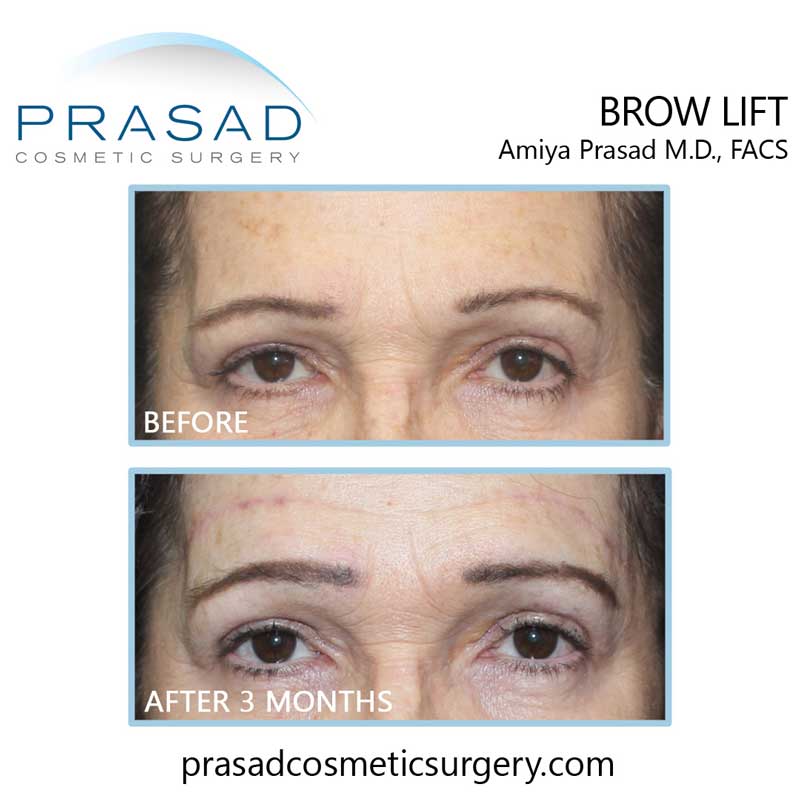 brow lift surgery before and after