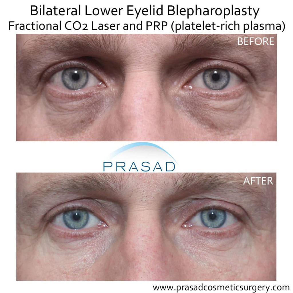 before and after male upper and lower eyelid blepharoplasty with fractional CO2 laser and platelet rich plasma PRP