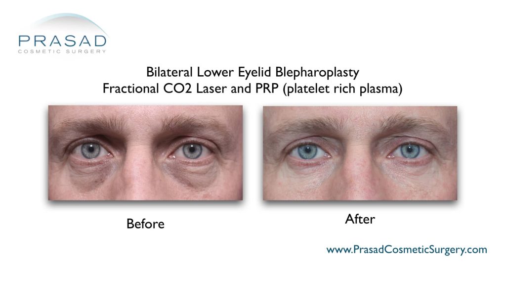 before and after male upper and lower eyelid blepharoplasty with fractional CO2 laser and platelet rich plasma PRP