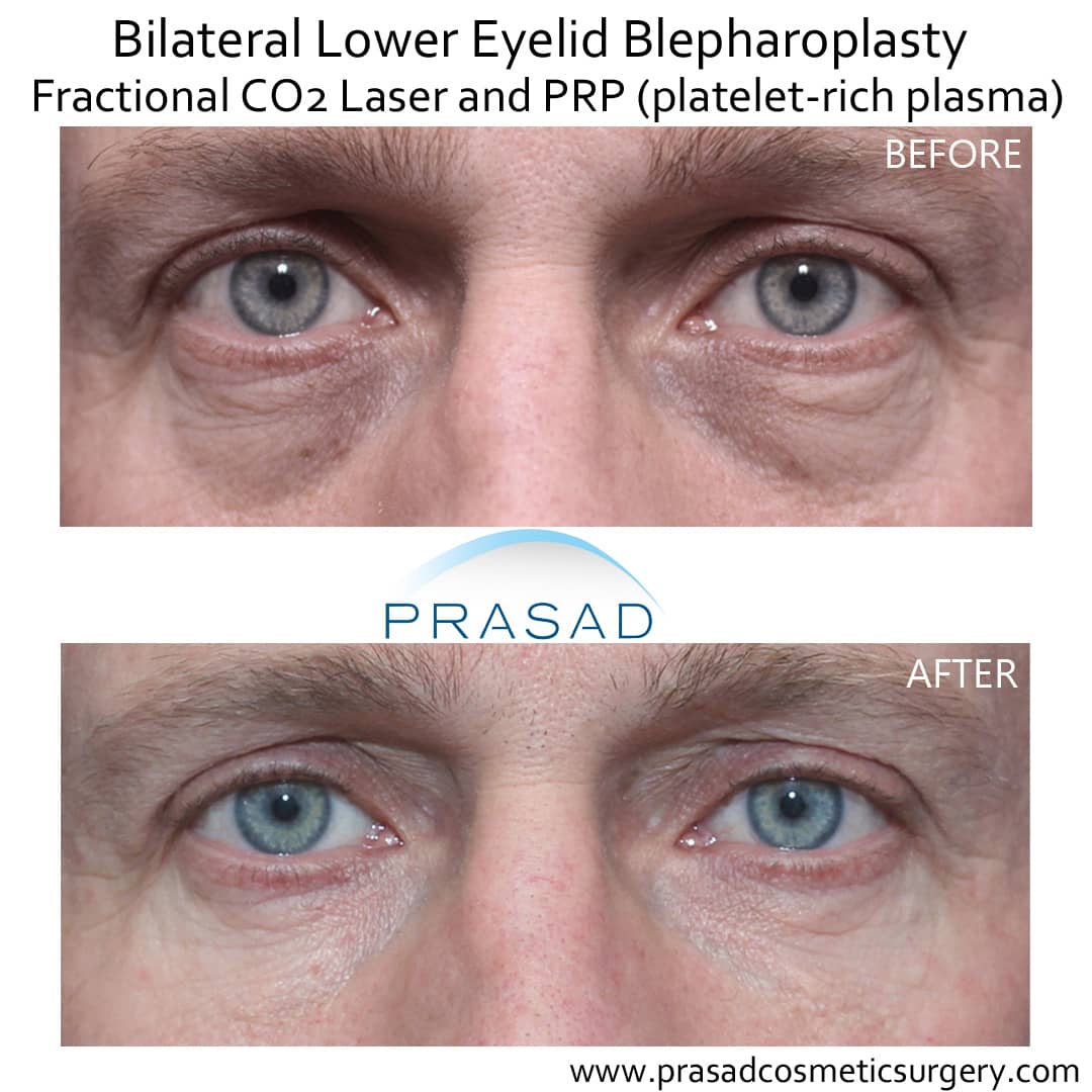 before and after male upper and lower eyelid blepharoplasty with fractional CO2 laser and platelet rich plasma PRP under eyes