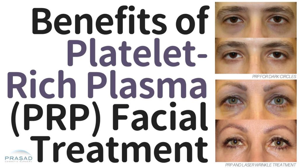 benefits of PRP facial treatment
