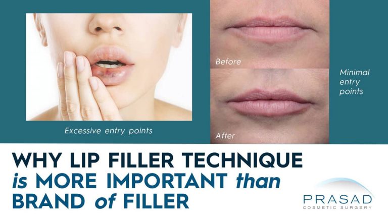 why lip filler technique is more important than brand of filler